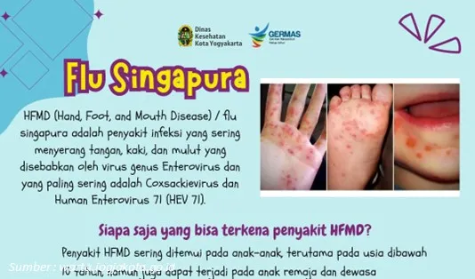 Cara Mengobati Flu Singapura pada Anak Secara Alami